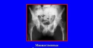 Рентген костей при раке простаты