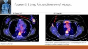 Что такое пэт кт при раке молочной железы