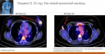 Что такое пэт кт при раке молочной железы