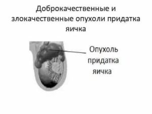 Как определить опухоль от придатка яичка