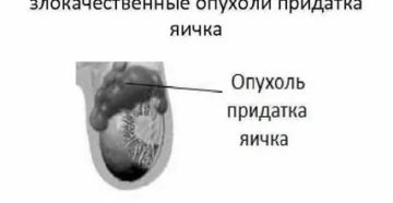 Как определить опухоль от придатка яичка