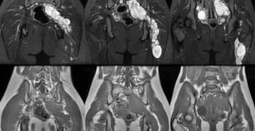 Можно ли делать мрт позвоночника при миоме матки
